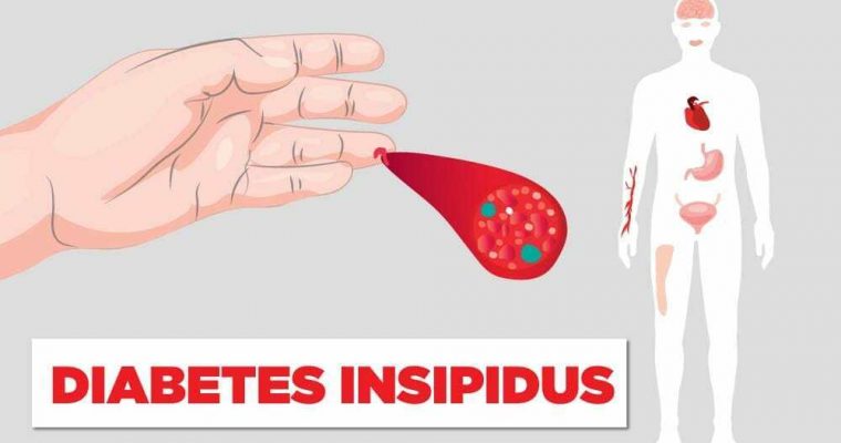 Diabetes tidak Selalu Berkaitan dengan Gula
