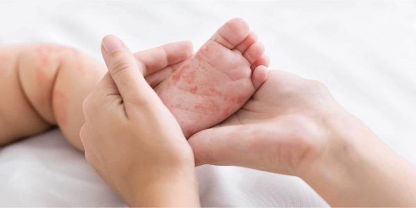 alergi pada kulit bayi